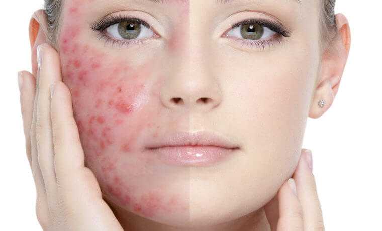 acne ekomed