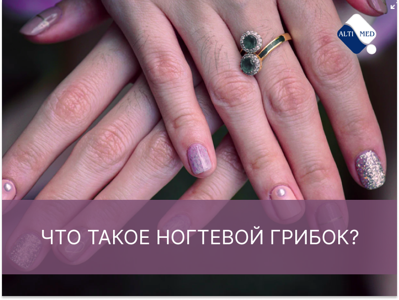 Что такое ногтевой грибок?