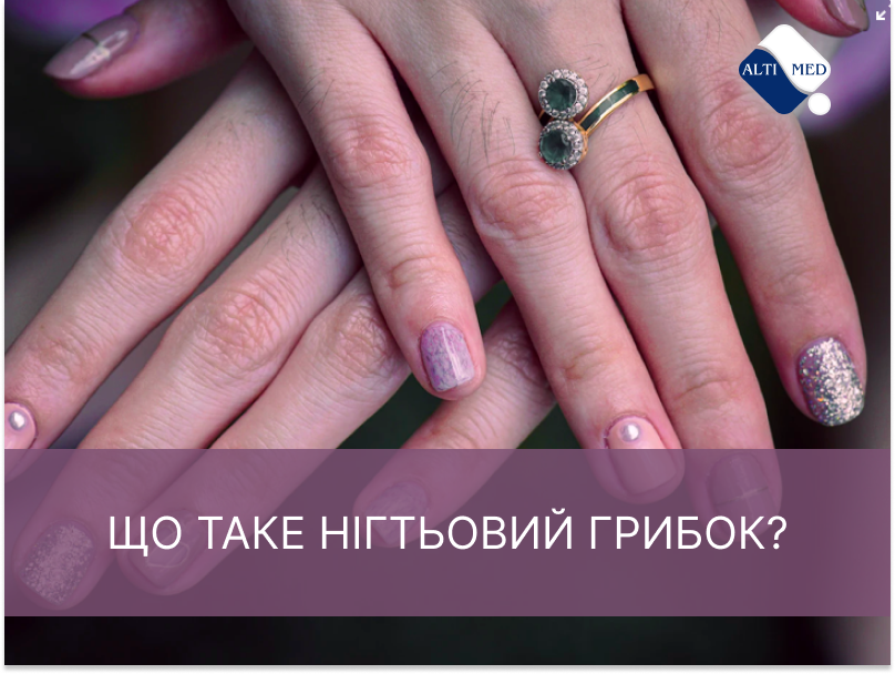 Що таке нігтьовий грибок?